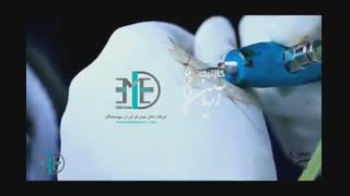 کاشت مو به روش SFT برای اولین بار در کلینیک تخصصی آریامن