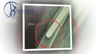 شکستگی پری پروستتیک (اطراف استم)