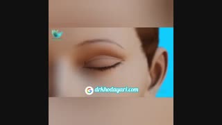 نحوه برش زدن پلک بالا و پایین در عمل بلفاروپلاستی