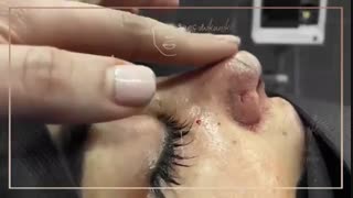 فیلم واقعی جراحی بینی