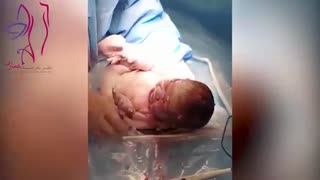 فیلم بدون سانسور زایمان سزارین