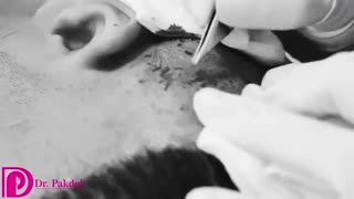 کاشت ریش چگونه انجام می شود؟ فیلم,قیمت,عوارض