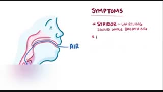 درمان نرمی حنجره در گرگان_09358471844