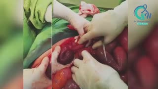 علائم انسداد روده (عدم دفع مدفوع)