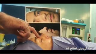 اصلاح کجی بینی گوشتی توسط دکتر امید ابراهیمی بهترین جراح بینی در تهران