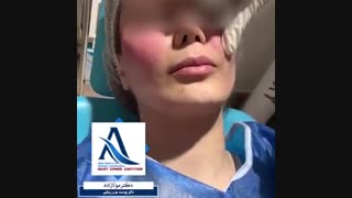 کانتورینگ صورت با تزریق چربی برداشتن خال گوشتی