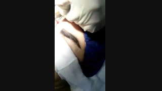 عمل کاشت ابرو