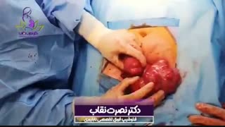 فیلم واقعی جراحى فیبروم رحمى قبل از انتقال جنین