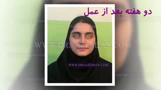 فیلم نتیجه جراحی زیبایی بینی