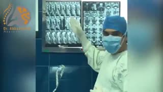 فیلم جراحی کانال نخاع گردنی