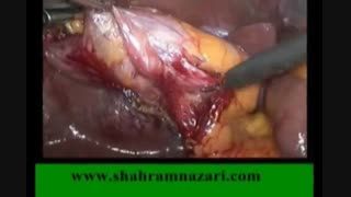 فیلم جراحی لاپاروسکوپی کله سیستکتومی ساعت شنی و آموزش آناتومی