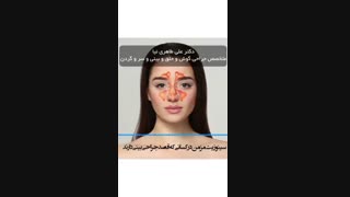 فیلم واقعی  درمان سینوزیت مزمن با عمل بینی