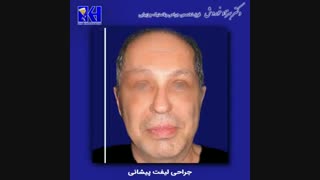 جراحی لیفت پیشانی