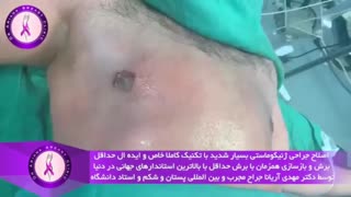 جراحی ژنیکوماستی با تکنیک خاص