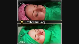 عمل زیبایی بینی قوزدار توسط دکتر امید ابراهیمی بهترین جراح بینی در تهران