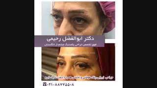 جوانسازی صورت با جراحی پلک