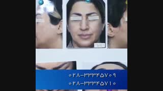 جراحی همزمان بینی و بلفاروپلاستی پلک بالا