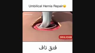 انیمیشن عمل فتق ناف