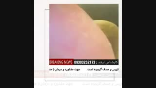 درمان قطعی و بدون بازگشت پسوریازیس...ایران موفق به کشف دارو گردید