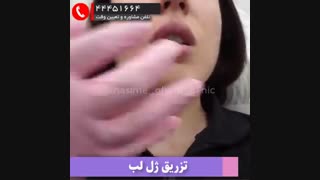 تزریق ژل لب ژوویدرم