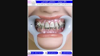 خلاصه مراحل درمان ارتودنسی ثابت و ردیف شدن دندانه | دکتر احسان مهریزی
