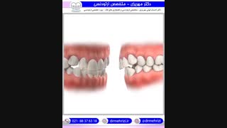 مرتب شدن دندانها با ارتودنسی ثابت و جفت شدن صحیح دندانها حین درمان | دکتر احسان مهریزی