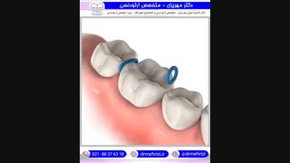سپریتور ( سپراتور ) یا همان جداکننده دندانها است | دکتر احسان مهریزی