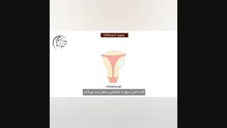 فیلم فیبروم و میوم رحمی
