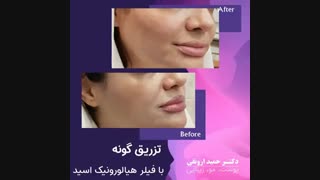 فیلم واقعی تزریق گونه با فیلر هیالورونیک اسید