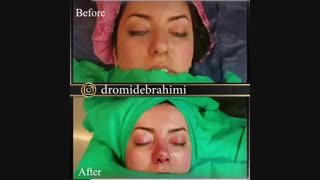 بلافاصله بعد از عمل بینی