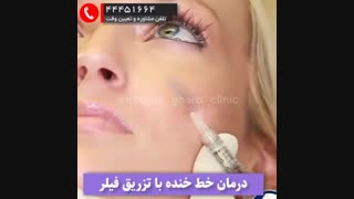 تزریق فیلر خط خنده