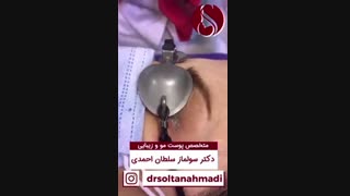 فیلم پاک کردن تتو