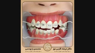 کشیدن دندان در ارتودنسی | دکتر فرهاد گرجی