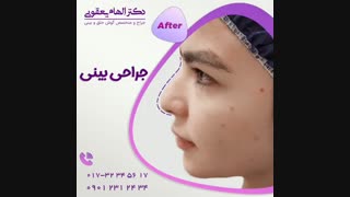 عمل زیبایی بینی