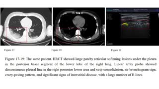 Lung Ultrasound in COVID 19: Findings, Accuracy, Pneumonia Diagnosis, Utility (POCUS)