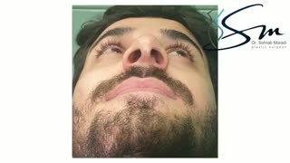 اصلاح نوک بینی و زاویه بین بینی و لب