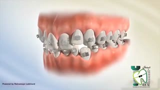 سیستم دیمون نوعی از براکت ارتودنسی است | کلینیک دندانپزشکی ایده آل