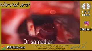 تومور  اپیدرموئید