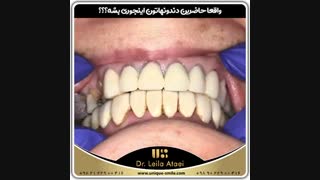 واقعا بنظرتون دلیل این کامپوزیت های فک پایین چی بوده؟ | دکتر لیلا عطایی