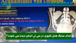 کدام سنگ های کلیوی در سی تی اسکن دیده نمی شود؟