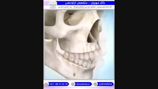 ارتودنسی همراه با جراحی فک | دکتر احسان مهریزی