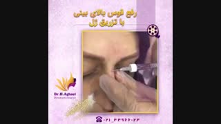 فیلم تزریق ژل به بینی ترمیم دندان