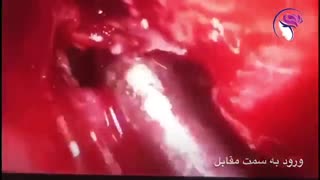 فیلم واقعی جراحی ترمیم آندوسکوپی شکستگی قاعده جمجمه