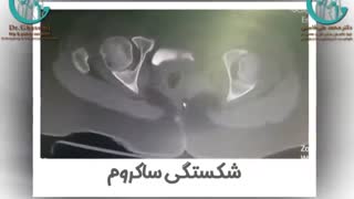 شکستگی پیچیده لگن از سه ناحیه