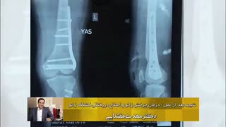 فیلم واقعی جراحی کشکک زانو
