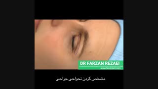 مرحل عمل بلفاروپلاستی