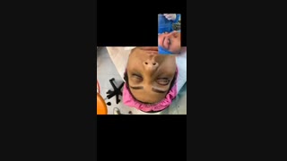 فیلم جراحی پلک بالا