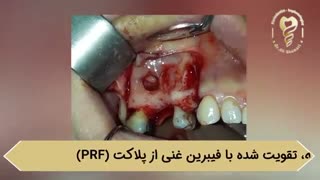 فیلم واقعی جراحی سینوس لیفت باز