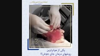 درمان جای جوش