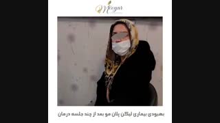 بهبودی ریزش موی ناشی از لیکن پلان